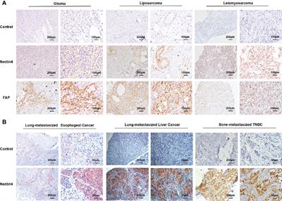 Development of Nectin4/FAP-targeted CAR-T cells secreting IL-7, CCL19, and IL-12 for malignant solid tumors